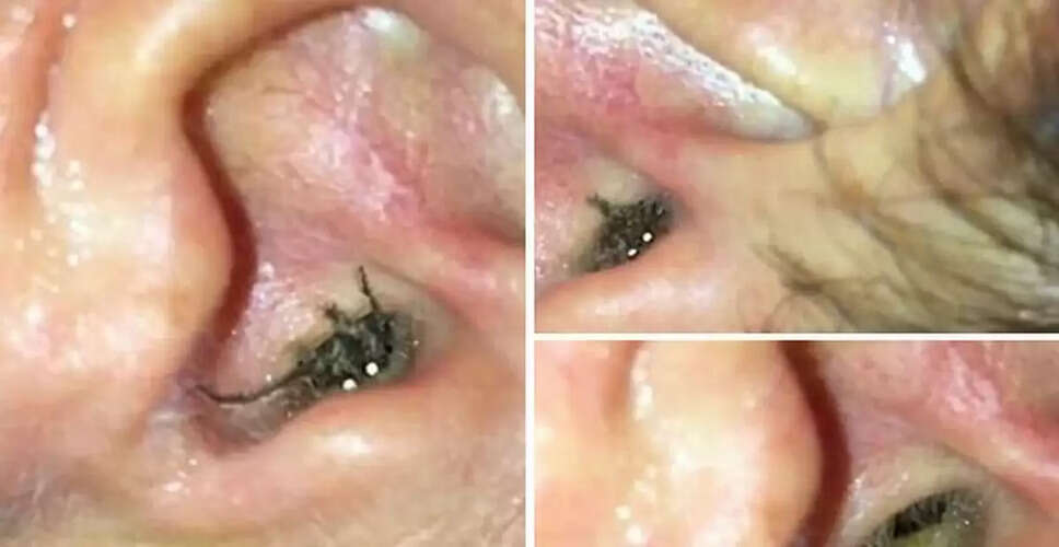 Creepy Crawler Alert: Scary Video of Big Spider Coming Out of Man's Ear Goes Viral and Scares Everyone
