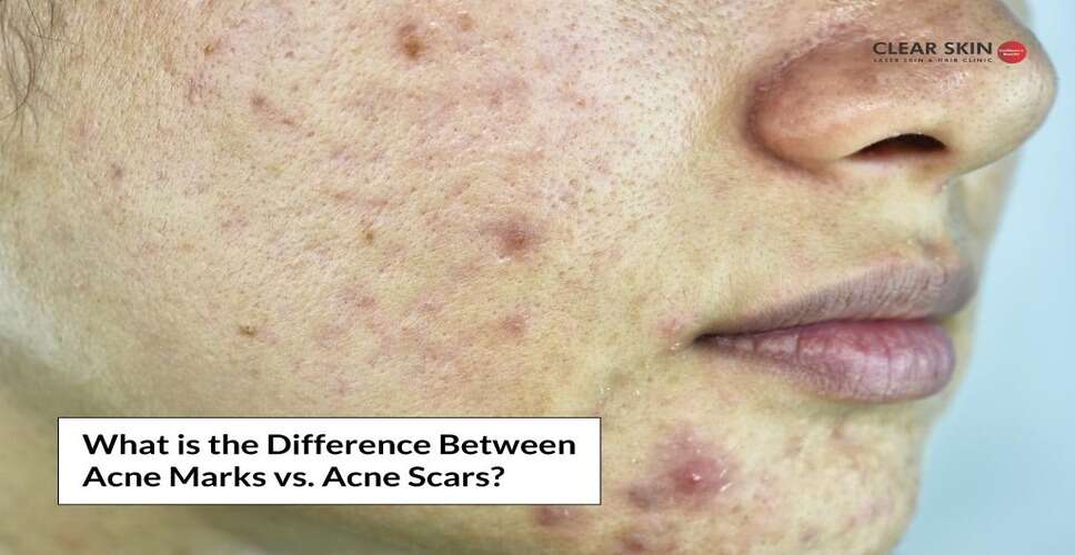 Understanding the difference between acne marks and scars will help you
