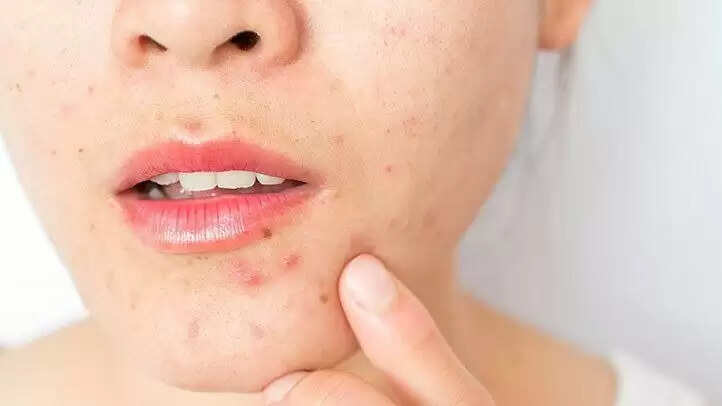 Heat Pimple Woes? Try These Natural Remedies for Quick Relief