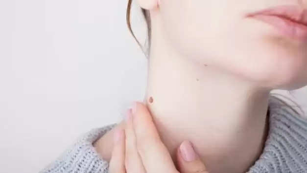 Skin Tags: Understanding What They Are and How They Form