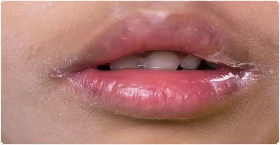 "Say Goodbye to Angular Cheilitis: 14 Effective Remedies for Quick Relief"