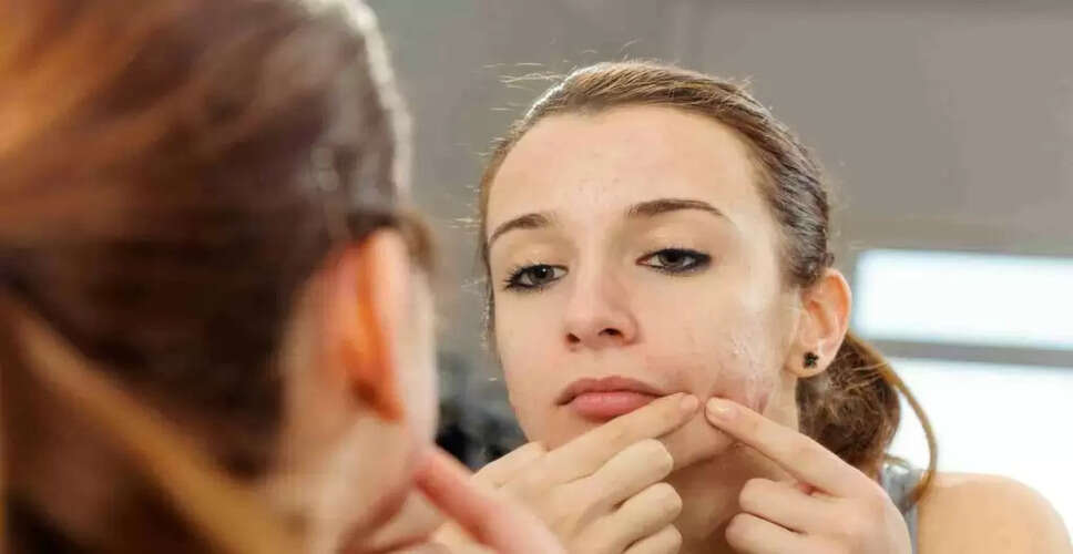Heat Pimple Woes? Try These Natural Remedies for Quick Relief