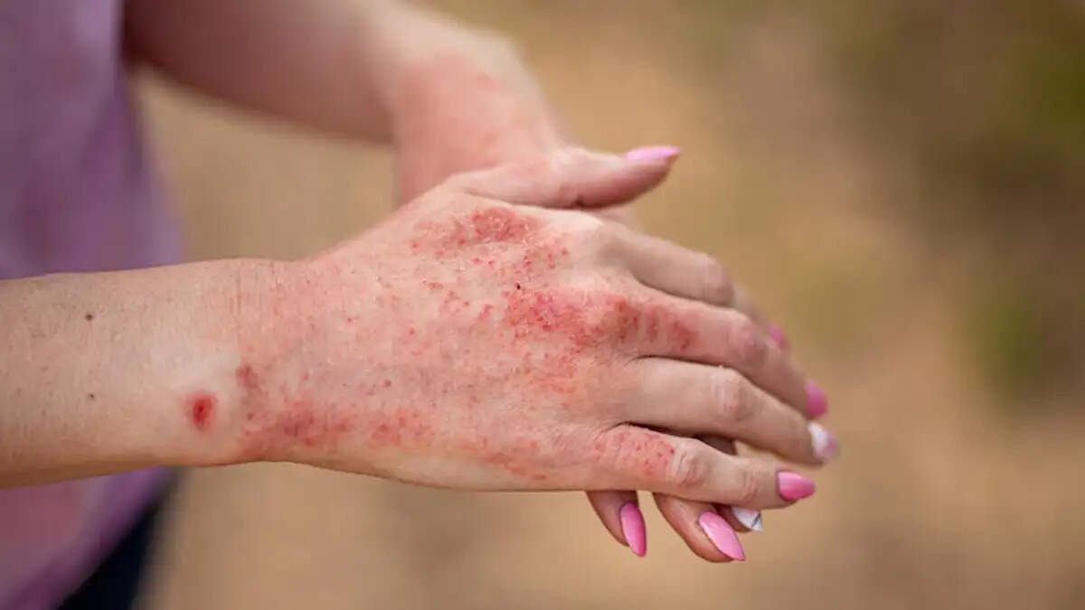 Dry, Peeling Hands? Try These Natural Remedies for Relief and Healing