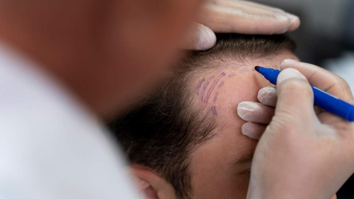 The Truth About Hair Transplants: Dispelling Common Myths