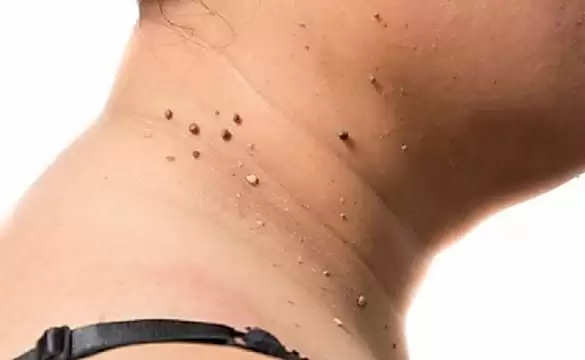 Skin Tags: Understanding What They Are and How They Form
