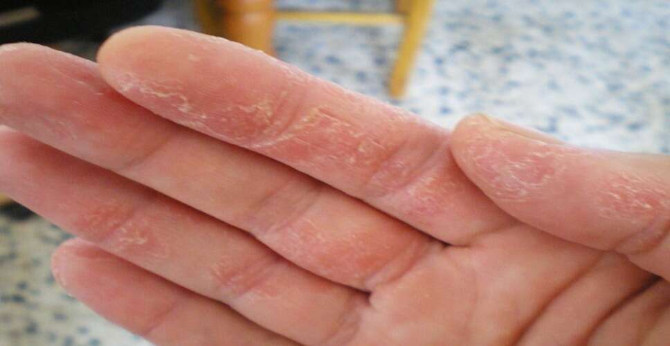 Dry, Peeling Hands? Try These Natural Remedies for Relief and Healing